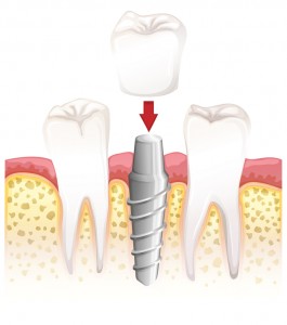 Denver dental implants