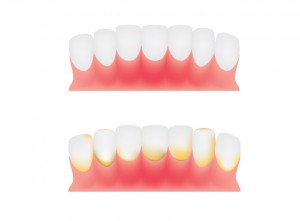 Denver periodontal treatment